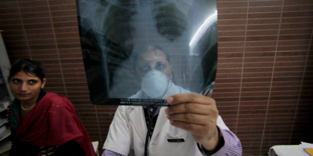 An Indian doctor examines a X-ray picture of a tuberculosis patient in a district TB center on World Tuberculosis Day in Jammu, India, Monday, March 24, 2014. India has the highest incidence of TB in the world, according to the World Health Organization's Global Tuberculosis Report 2013, with as many as 2.4 million cases. India saw the greatest increase in multidrug-resistant TB between 2011 and 2012. The disease kills about 300,000 people every year in the country. (AP Photo/Channi Anand)