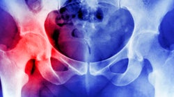 Osteoporosis Is Inevitable And Other Myths About The Bone