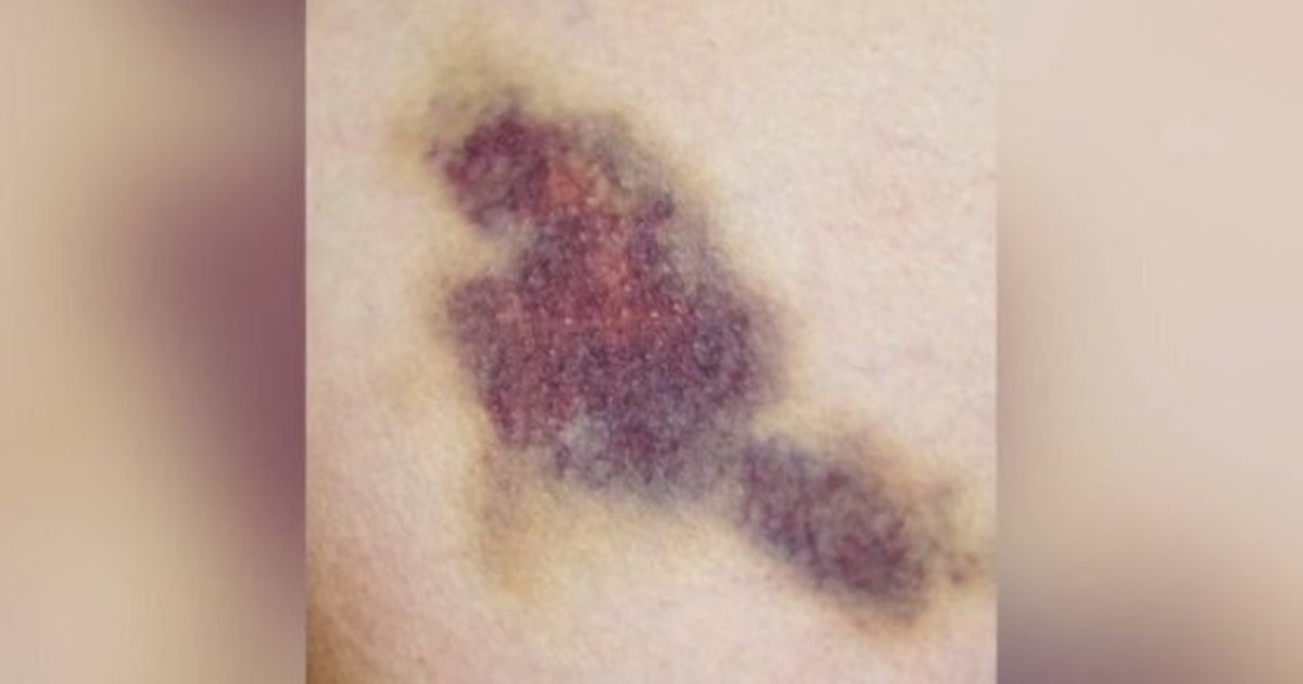 Bad Hickey