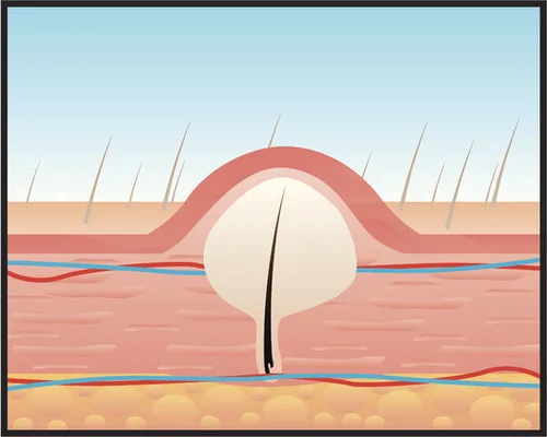 What Are Ingrown Hairs And How Can I Get Rid Of Them Huffpost
