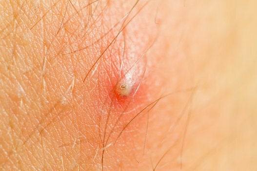What Are Ingrown Hairs And How Can I Get Rid Of Them Huffpost