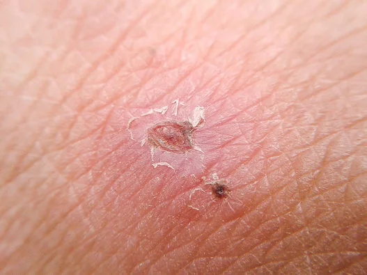 What Are Ingrown Hairs And How Can I Get Rid Of Them Huffpost