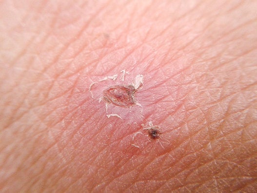 What Are Ingrown Hairs And How Can I Get Rid Of Them Huffpost