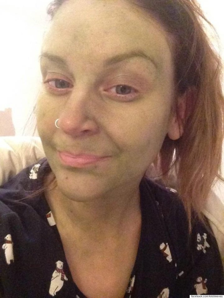 Fake tan turns woman green leaving her 'looking like Fiona from