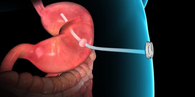 This rendering provided by Aspire Bariatrics, Inc. demonstrates the use of the AspireAssist weight loss device, approved by the Food and Drug Administration on Tuesday, June 14, 2016. The AspireAssist system consists of a thin tube implanted in the stomach, connecting to an outside port on the skin of the belly, which itself is connected to an external device, which helps remove nearly a third of the food stored in the stomach before calories are absorbed into the body, causing weight loss. (Aspire Bariatrics, Inc. via AP) MANDATORY CREDIT