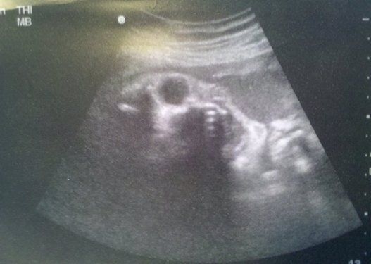 Creepy Ultrasound: 23 Images That Will Give You Nightmares | HuffPost  Parents