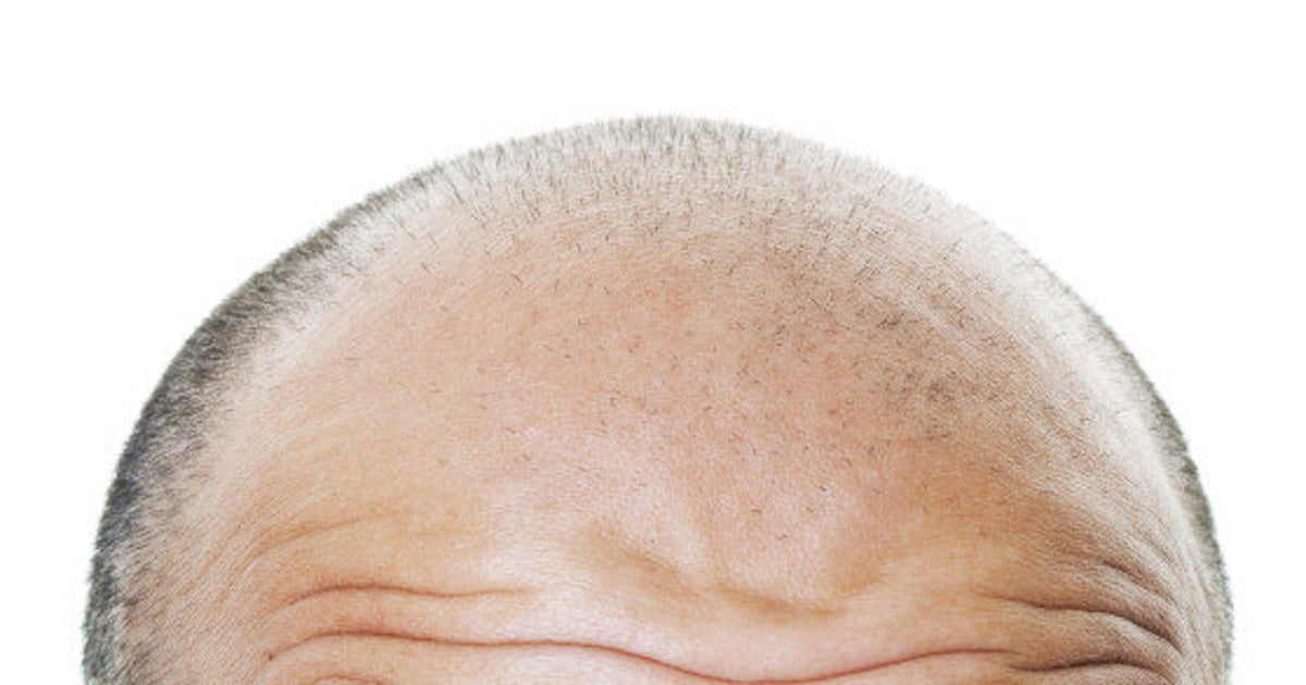 New Hair Loss Treatment Uses Baby Foreskins HuffPost Life