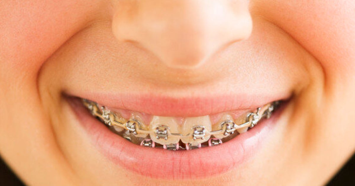 i-m-36-it-s-time-to-get-my-braces-off-huffpost-style