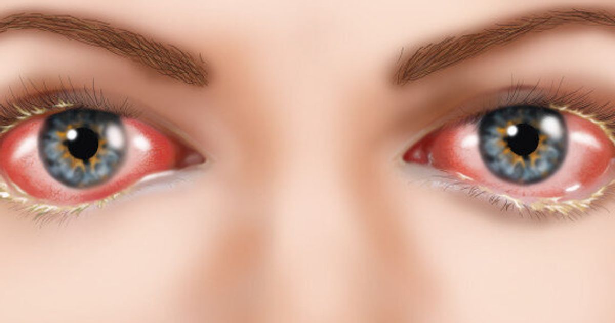 What Is Pink Eye And How Can You Prevent It? | HuffPost Canada