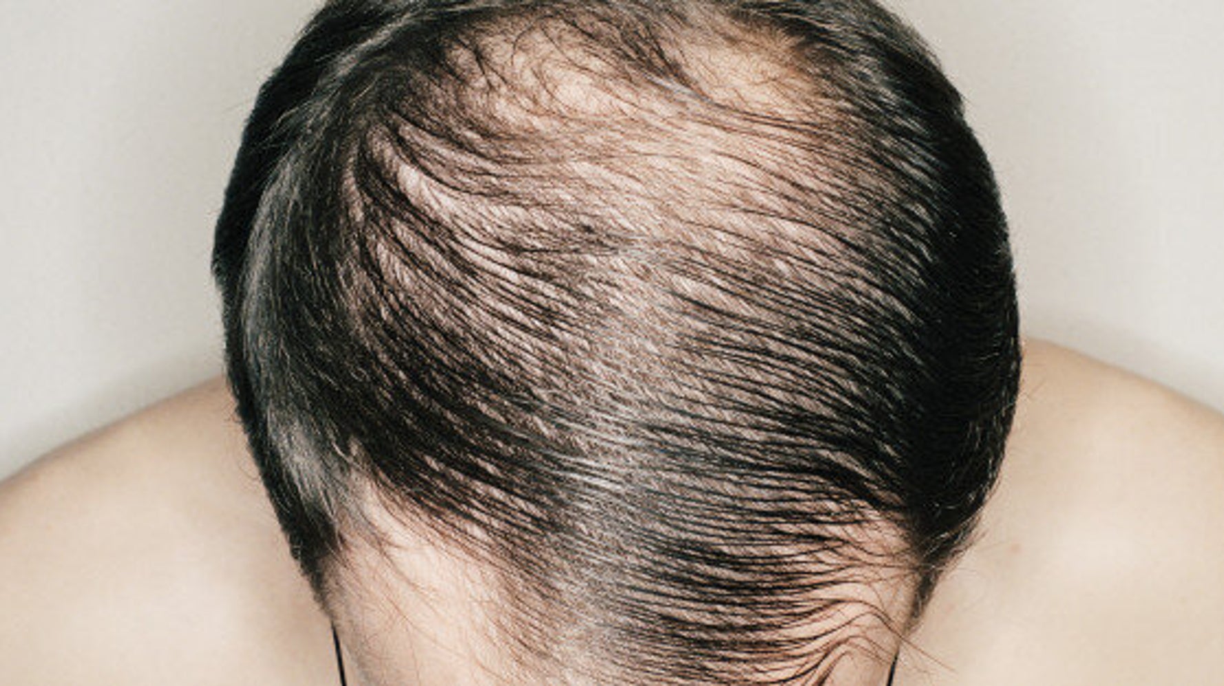 Why Do Men Go Bald?