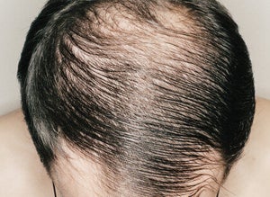 Men Hair Loss Huffpost Canada