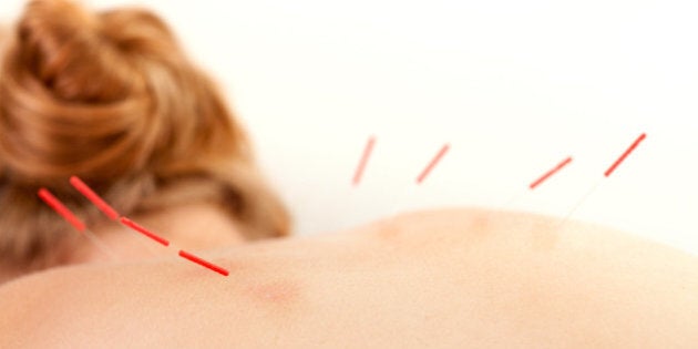 detail of acupuncture needles...