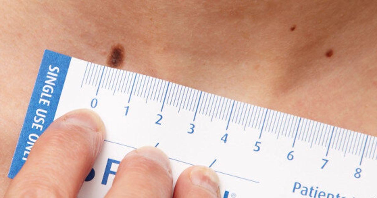 Skin Cancer 6 Ways To Check Your Moles Huffpost Life Skin Cancer 6 Ways To Check Your Moles Huffpost Life