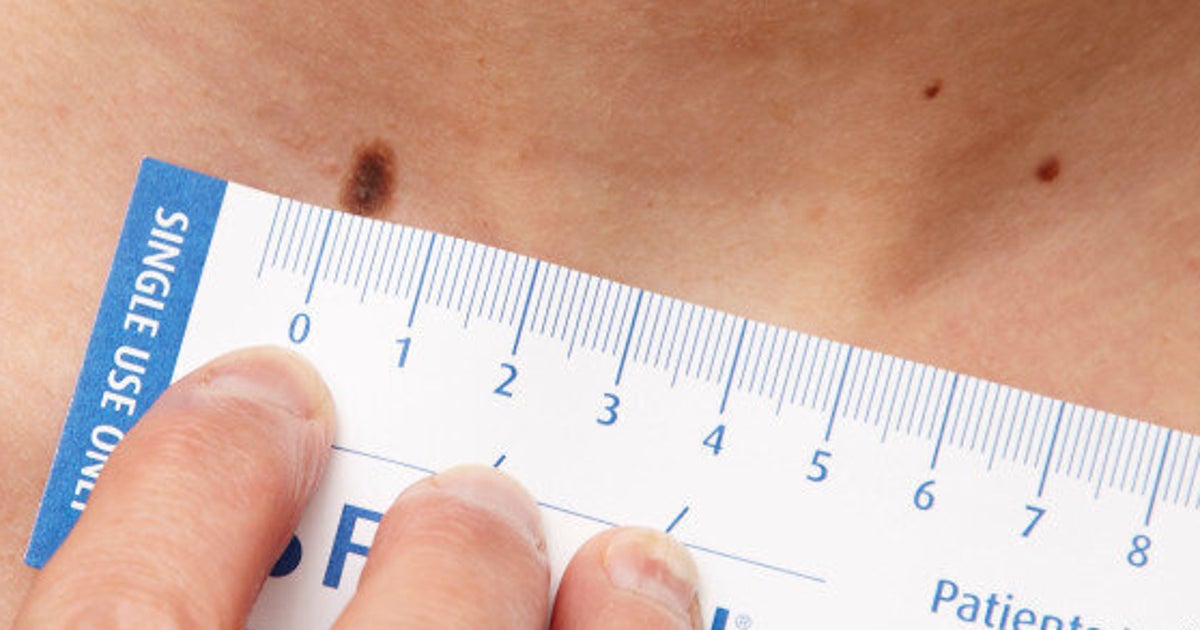 Skin Cancer 6 Ways To Check Your Moles Huffpost Life