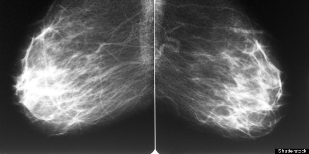 mammogram films of both breasts ...