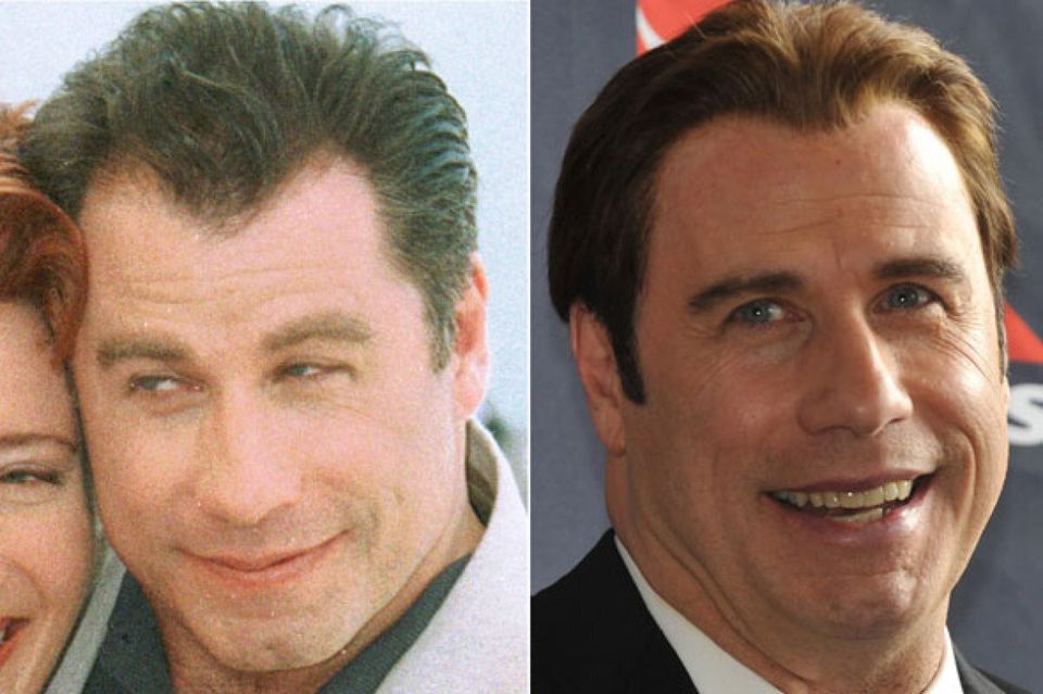 Hair Transplants - John Travolta