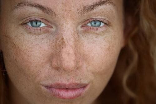 Age Spots And Freckles