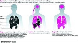Knowing The Facts About Sepsis Could Save Your