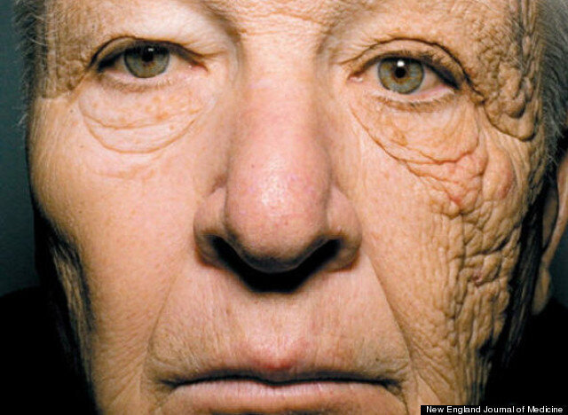 Bill McElligott Delivery Truck Driver Has Severe Sun Damage On One   5cd891762100005900cfbaff 