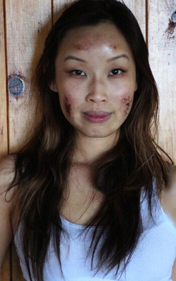 How A Chemical Peel At A Medi Spa Turned Me Into Road Rash Face Huffpost Canada Life