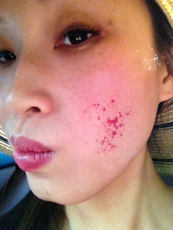 How A Chemical Peel At A Medi Spa Turned Me Into Road Rash Face Huffpost Canada Life