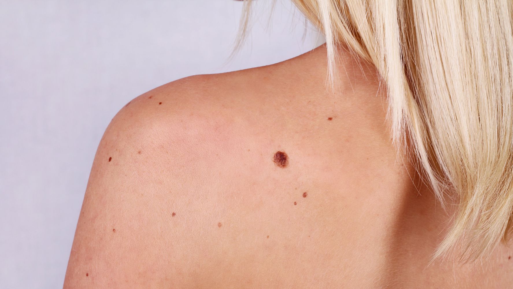 Mélanome : avez-vous le cancer de la peau? | HuffPost Vivre