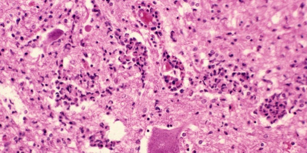 Poliomyelitis involving the anterior horn of the spinal cord in a young boy. H&E stain, LM X64.