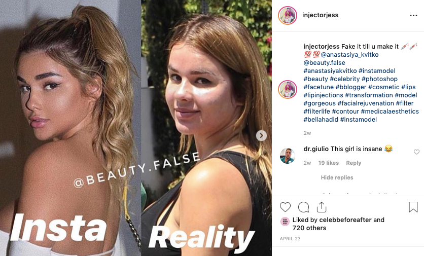 Aesthetic practitioners are "exposing" influencers as a way to market their services to young women on Instagram.