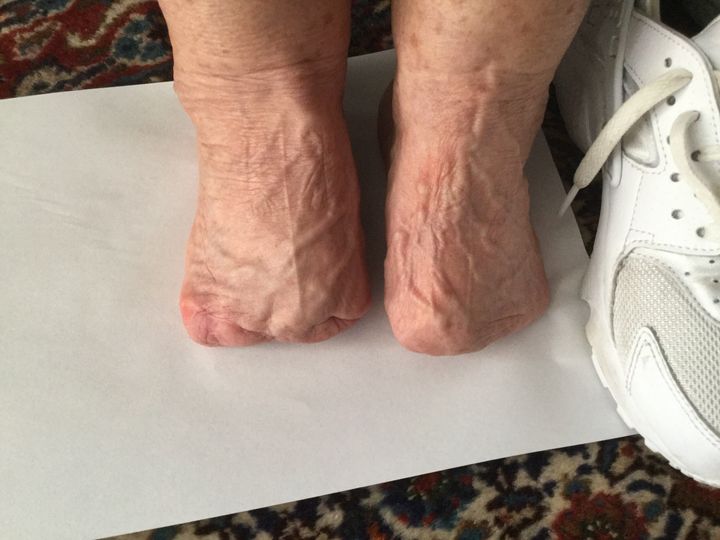Most of Joan Judge's feet have been amputated after she suffered a severe reaction to Nolotil, which led to gangrene