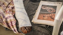 Mordeduras de serpiente, la epidemia