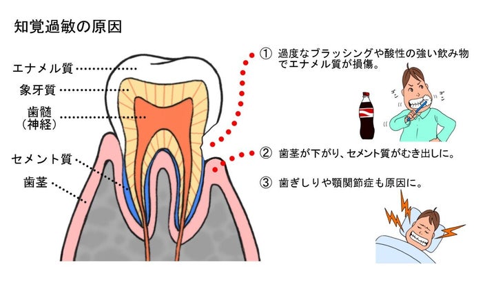 歯磨きが強すぎるとエナメル質が削れ、知覚過敏になる可能性が出てくるが、一方で歯が汚れたままだと知覚過敏だけでなく、虫歯にもなりやすくなるので、口の中を清潔にしておくことが大切だ