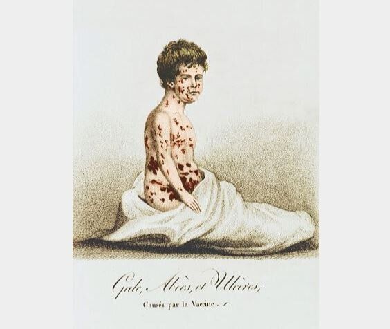 Ασθενής με ευλογία τέλη του 19ου αιώνα.