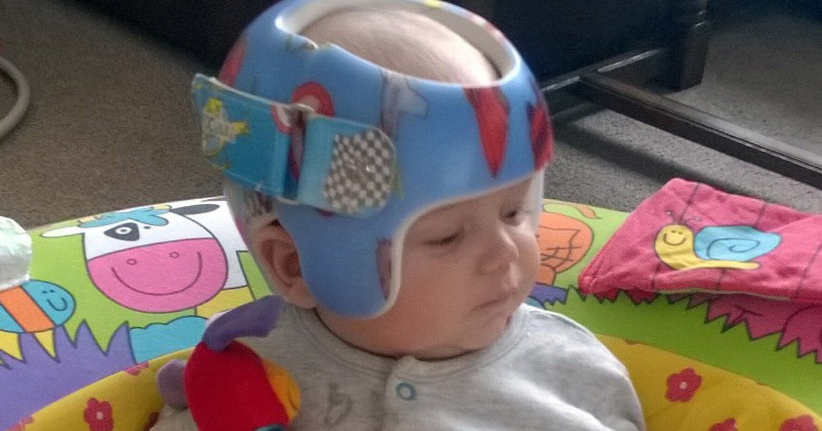 Baby Whose Head Is 'As Wide As It Is Long' Fitted With Helmet To Make