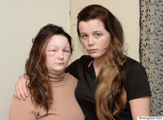 Sisters Left With Swollen, Scab-Covered Heads After Allergic Reaction To Salon Hair Dye | HuffPost UK Life Sisters Left With Swollen, Scab-Covered Heads After Allergic Reaction To Salon Hair Dye | HuffPost UK Life
