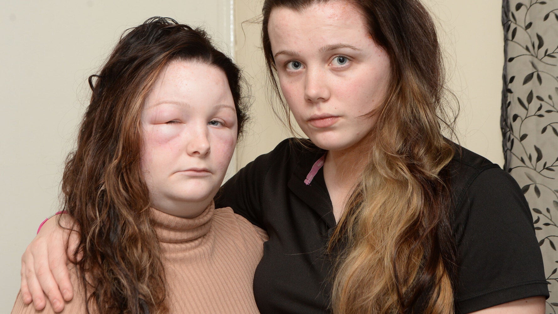 Sisters Left With Swollen, Scab-Covered Heads After Allergic Reaction To Salon Hair Dye | HuffPost UK Life Sisters Left With Swollen, Scab-Covered Heads After Allergic Reaction To Salon Hair Dye | HuffPost UK Life