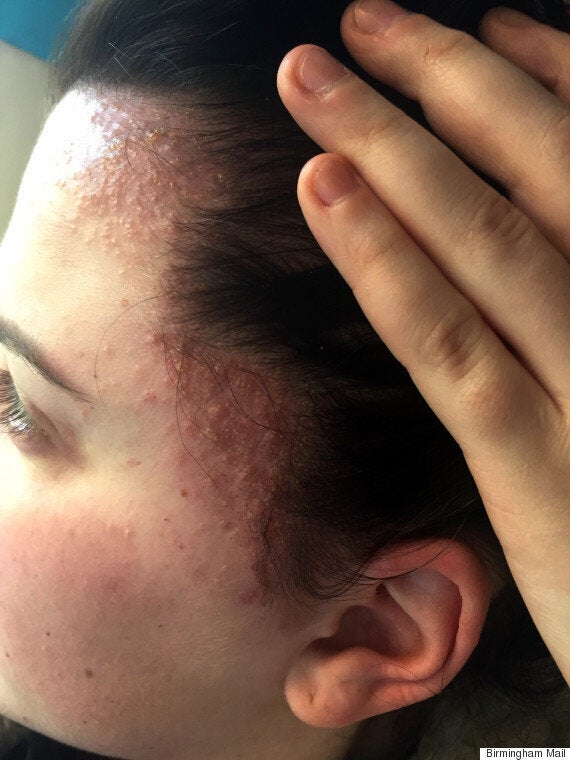 Аллергия на шапку на лбу фото Sisters Left With Swollen, Scab-Covered Heads After Allergic Reaction To Salon H