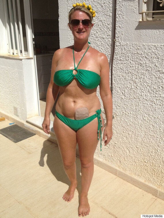 Suzanne Dore, Blogger With Bowel Cancer, Shares Colostomy Fashion