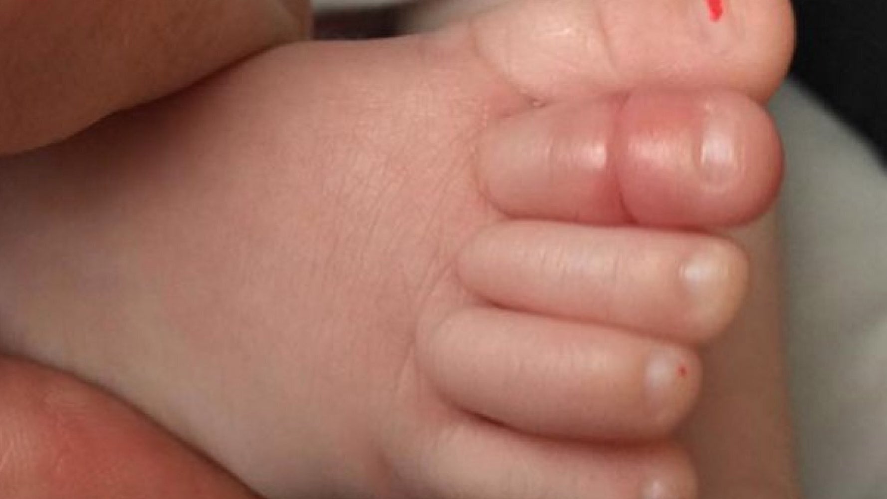 Dad Shares Shocking Photo Of Baby's Toe To Warn Parents Of Dangerous