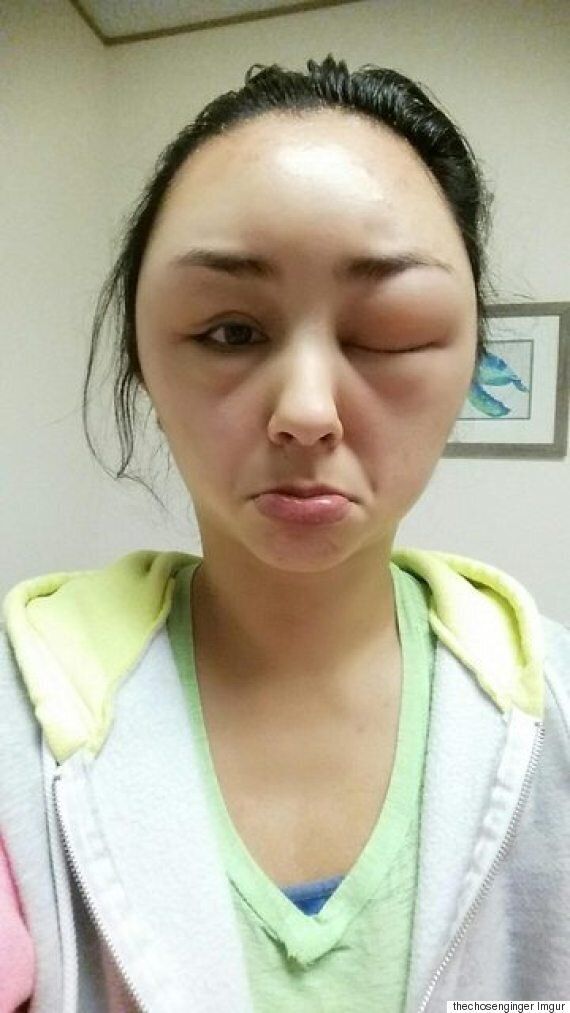 Shocking Photos Show Woman's Ballooning Face After Allergic Reaction To ... Makeup Allergic Reaction