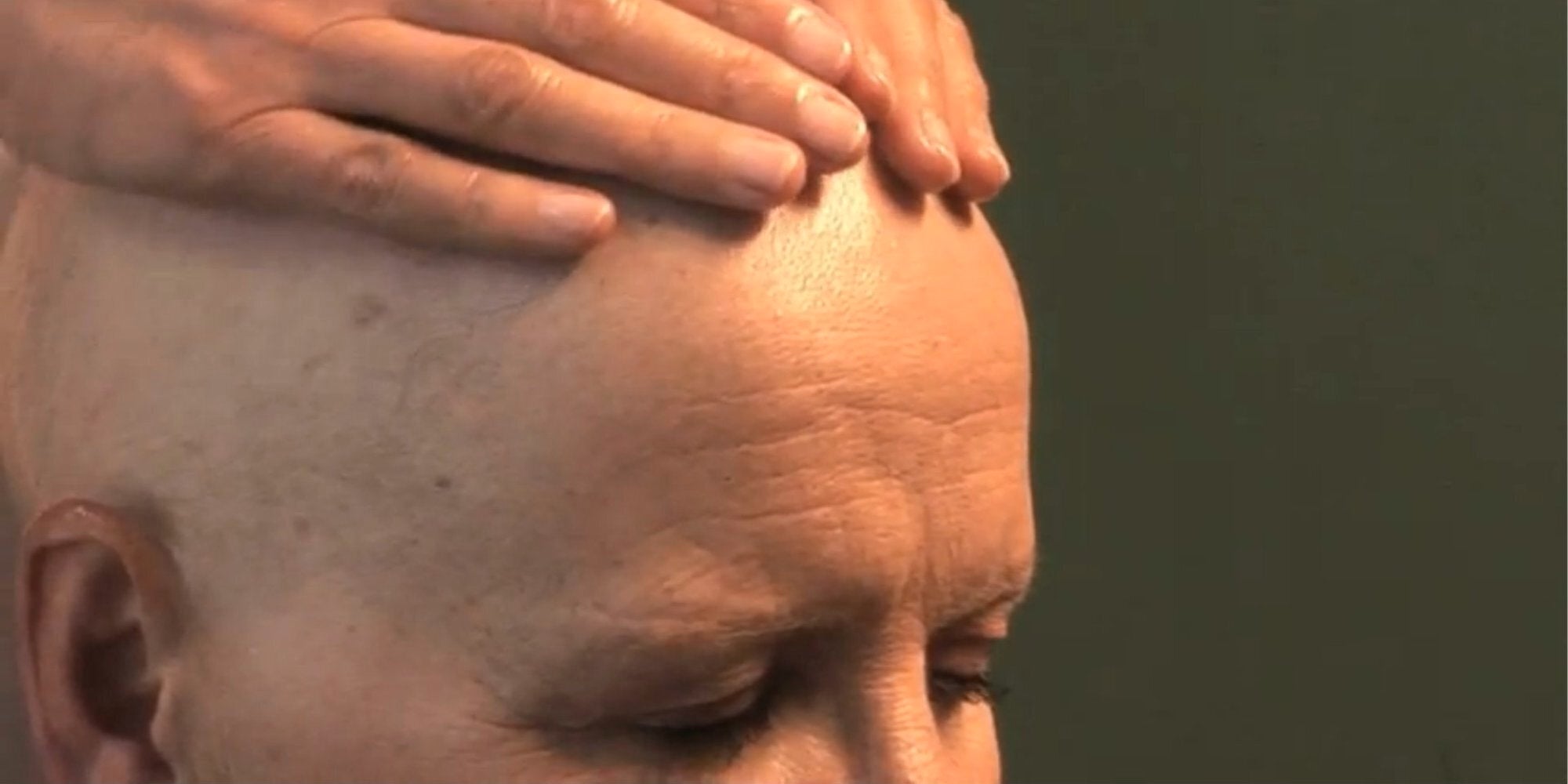 chemotherapy hair loss