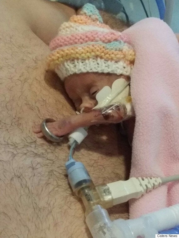Premature Baby Born At 27 Weeks Is So Tiny Her Dad�s