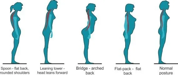 Could Poor Posture Be Causing Your Back Pain? This Graphic Reveals If  You're Standing Correctly