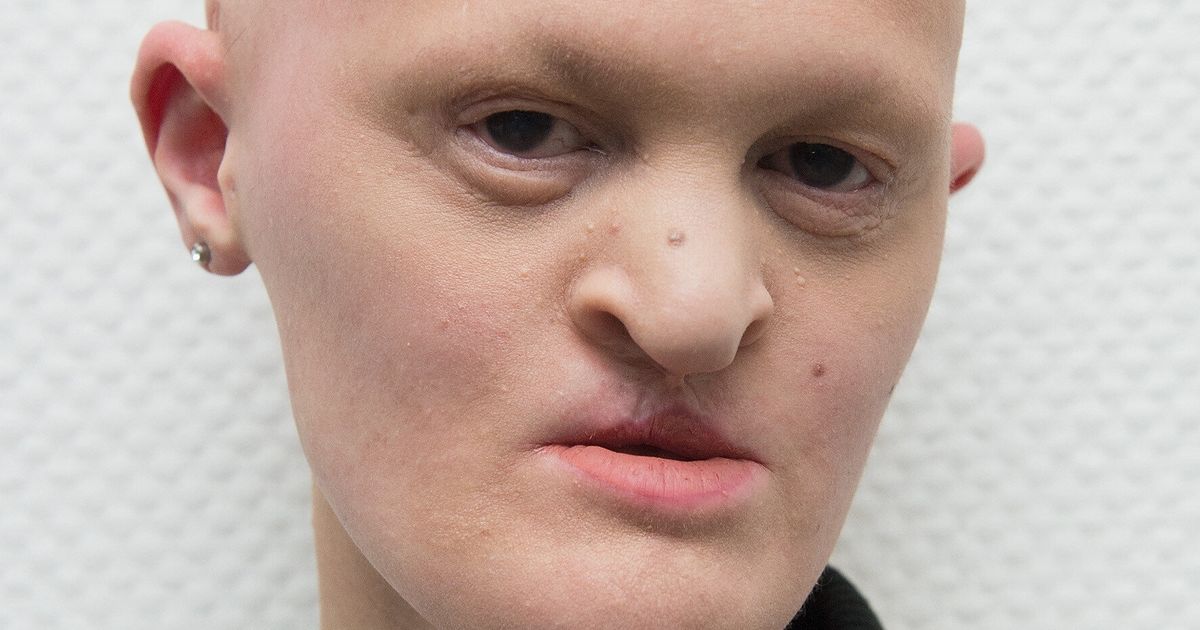 Melanie Gaydos Model With Ectodermal Dysplasia Is Making Waves In The Fashion World Huffpost