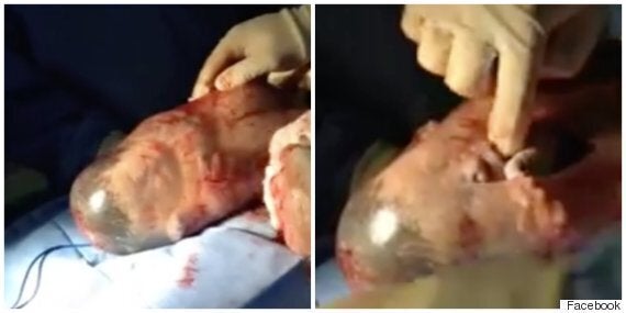 Fascinating Video Shows Baby Born Inside Amniotic Sac Take First Breath Huffpost Uk Parents