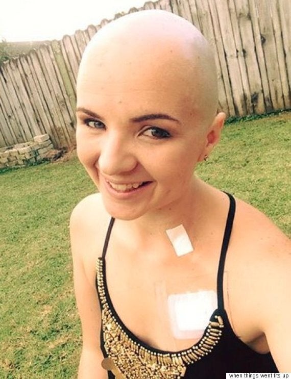 Breast Cancer Patient Shaves Head in Because of Chemo Hair Loss