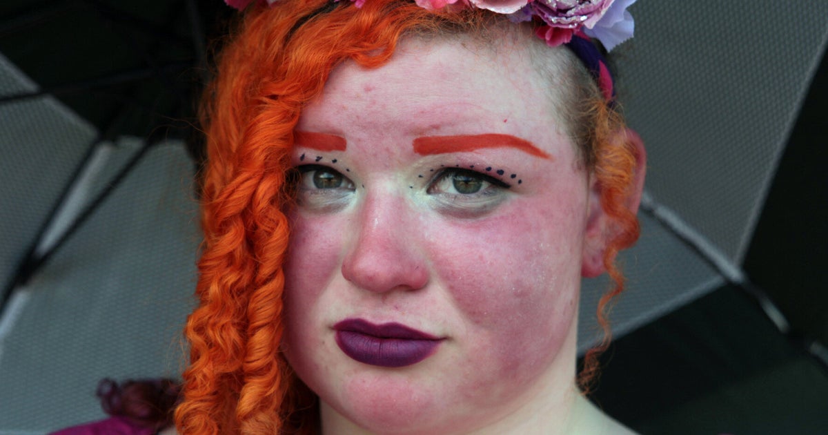 Woman Feels Like She's 'Burning Alive' Because Of Rare Skin Condition