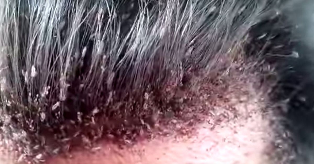 Head Lice Infestation Video Is So Gross You Shouldn't Watch It ...