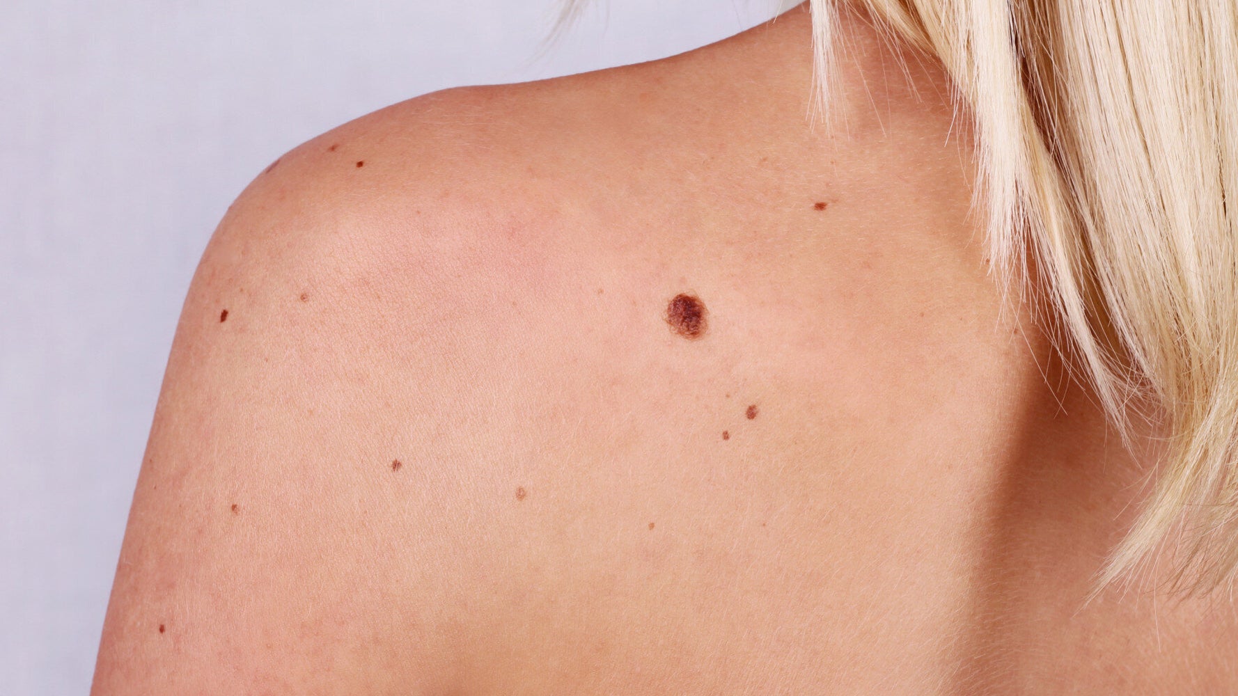 Majority Of Melanoma Skin Cancer Patients 'Do Not Have Irregular Moles