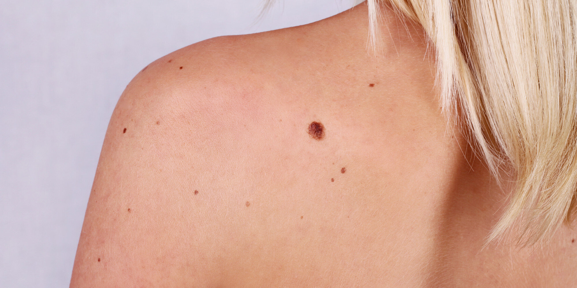 Majority Of Melanoma Skin Cancer Patients Do Not Have Irregular Moles 