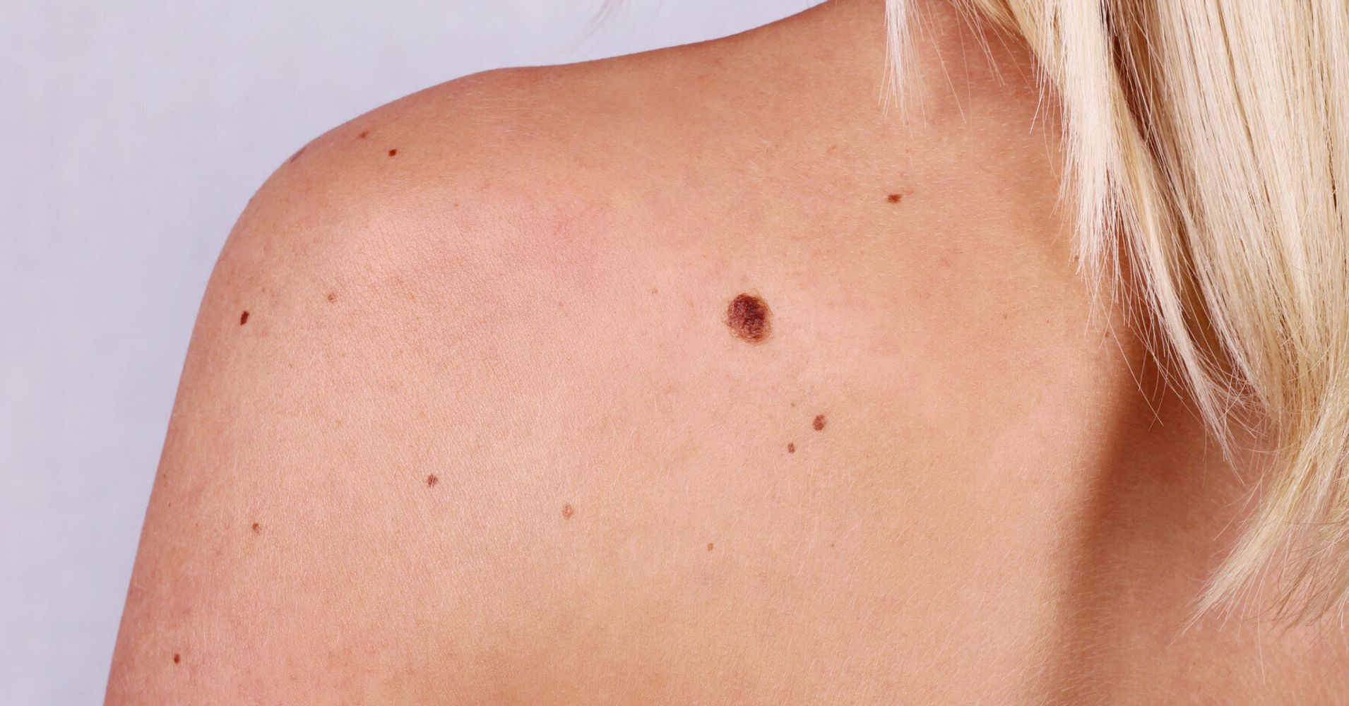 Majority Of Melanoma Skin Cancer Patients Do Not Have Irregular Moles